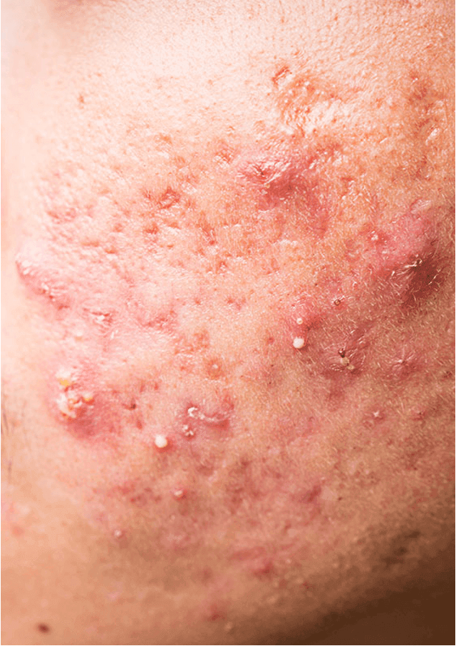 Acne and comedonal disease​
