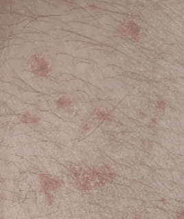 Disseminated Superficial Actinic Porokeratosis​