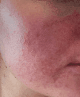 Rosacea​