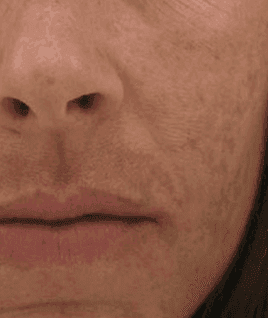 Melasma and dyschromia​