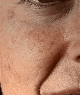 Photoageing and texture change​